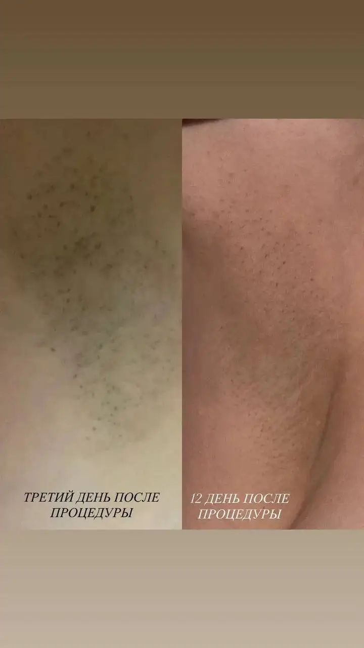 Лазерная эпиляция в Краснодаре - Красота (Услуги) в Краснодар