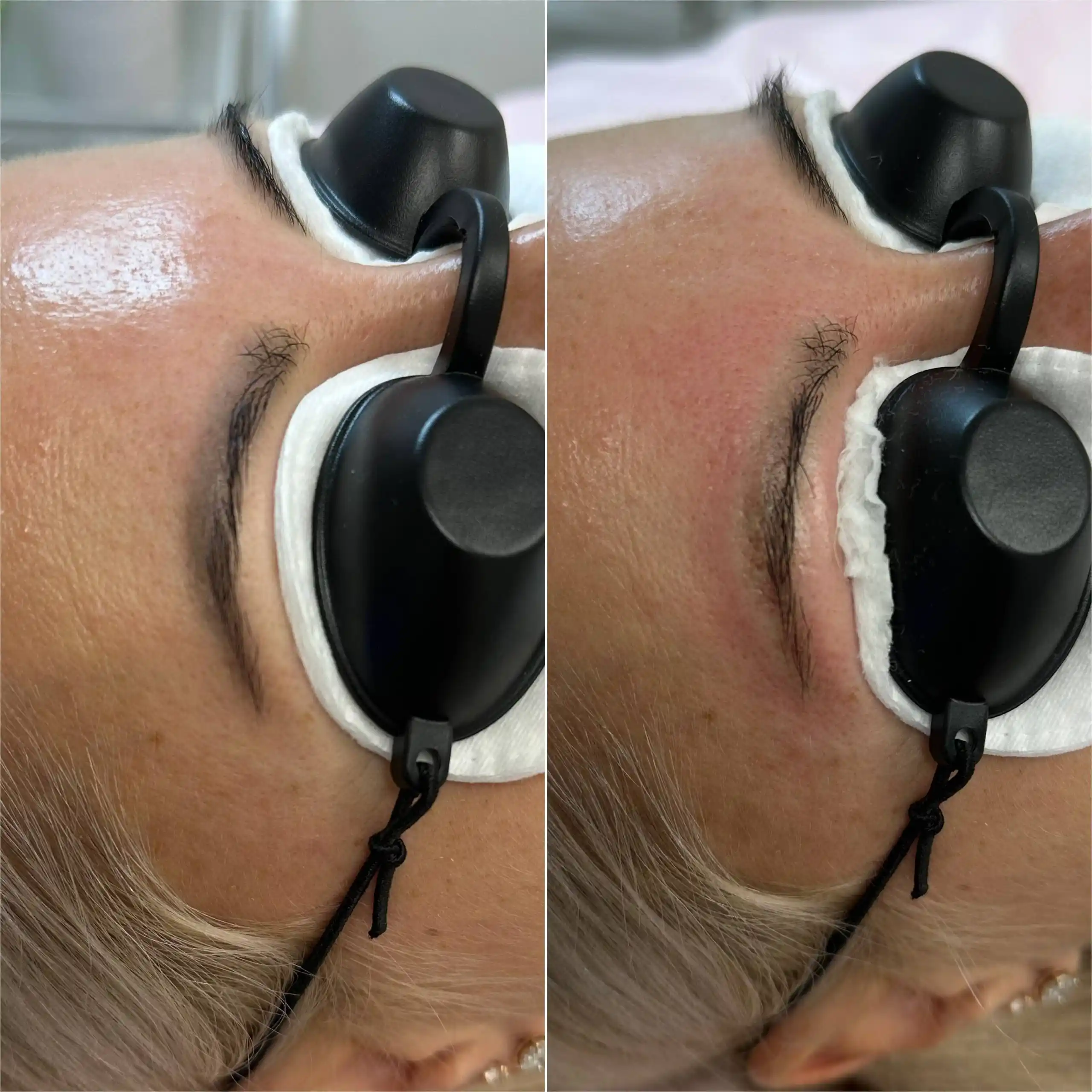 Удаление некачественного татуажа бровей лазером - Услуги в Орск-Новотроицк