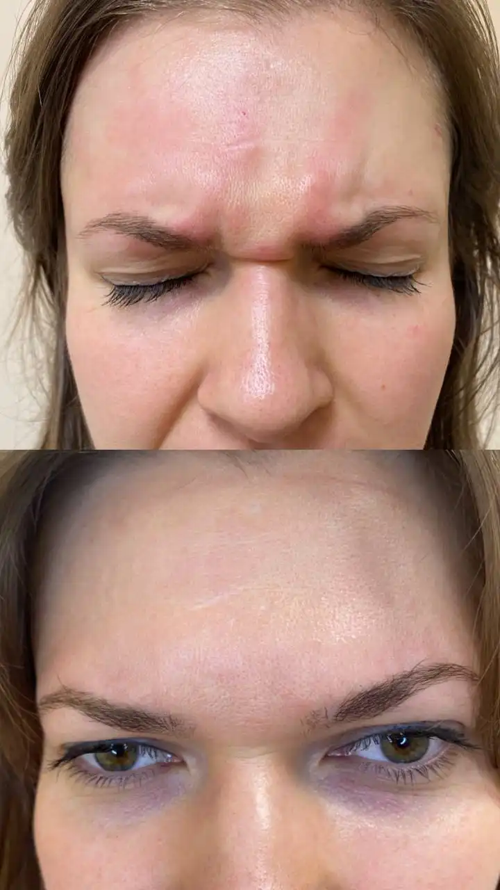 Ищу моделей на процедуру ботокс