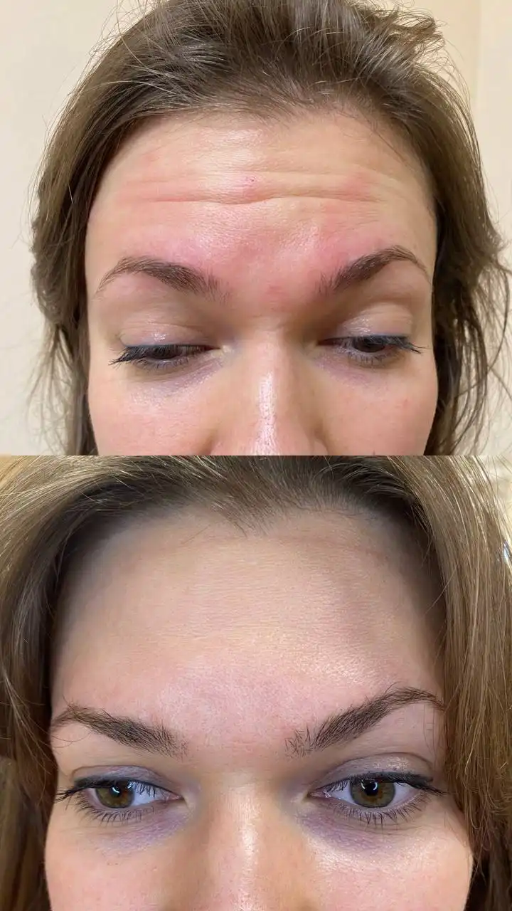 Ищу моделей на процедуру ботокс