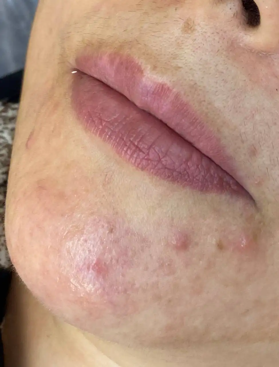 Услуги косметолога по увеличению губ