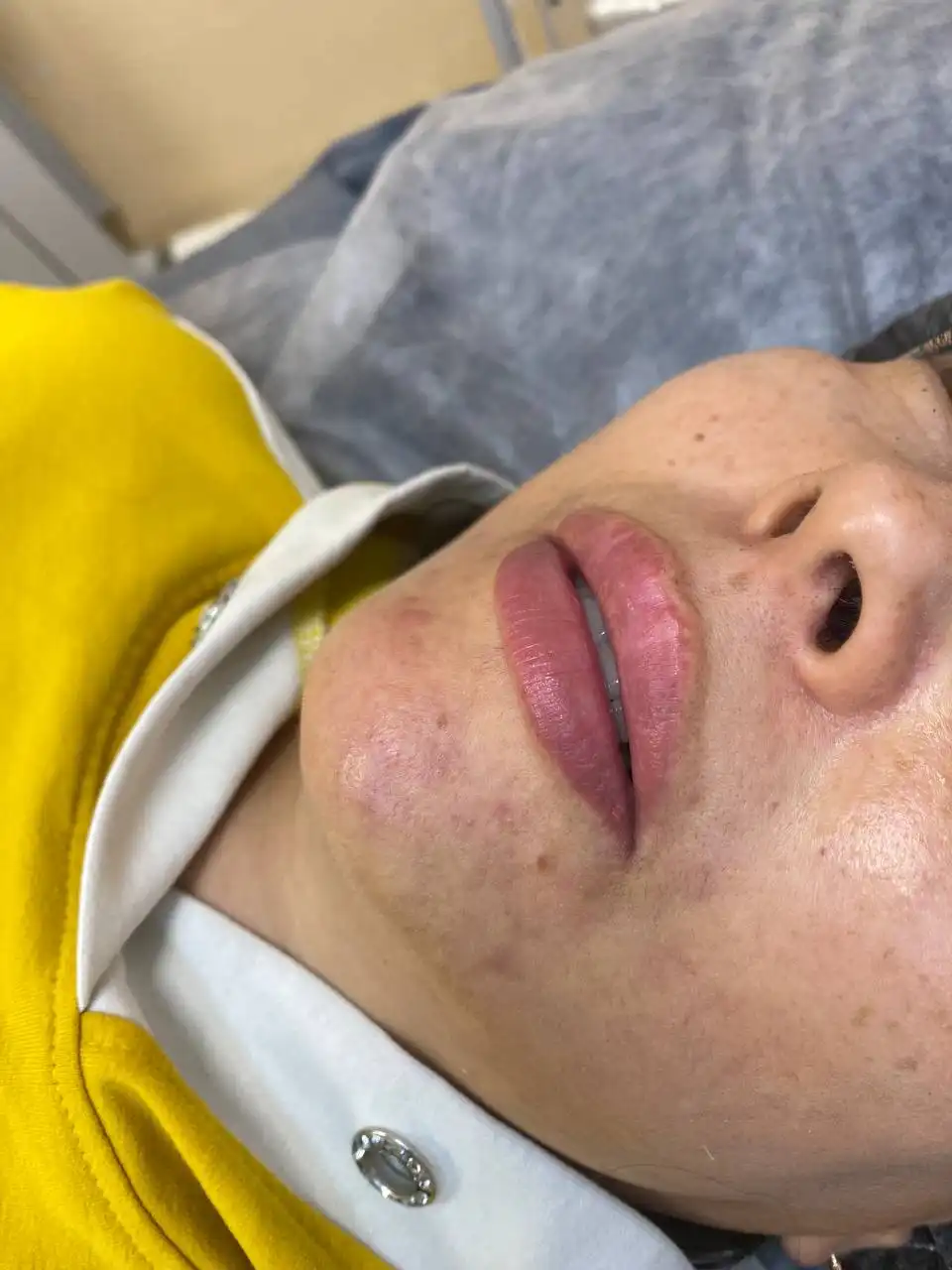 Услуги косметолога по увеличению губ