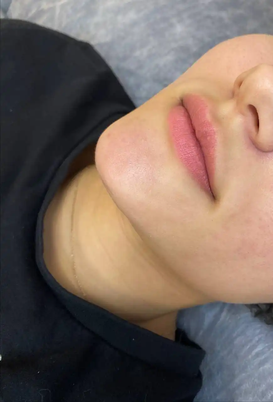 Услуги косметолога по увеличению губ