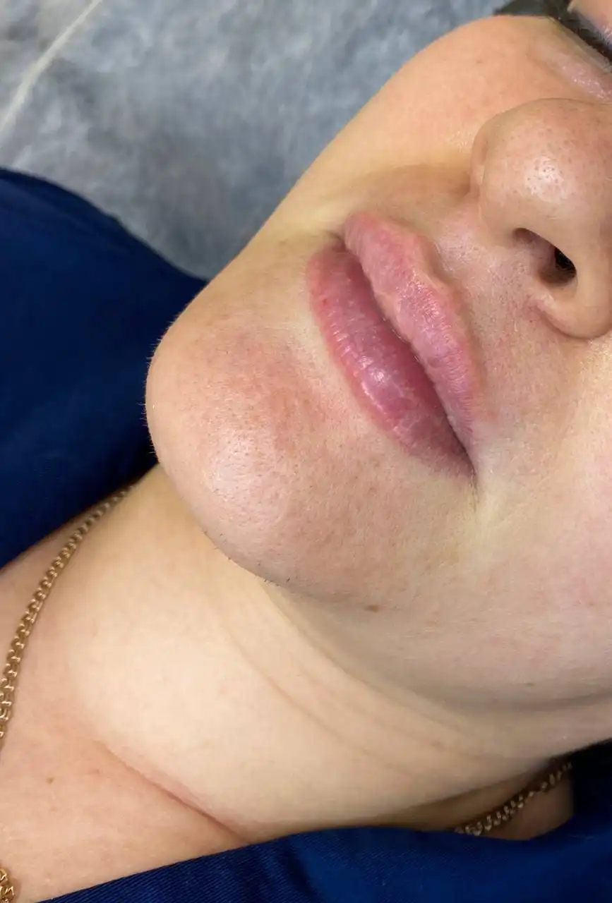 Услуги косметолога по увеличению губ