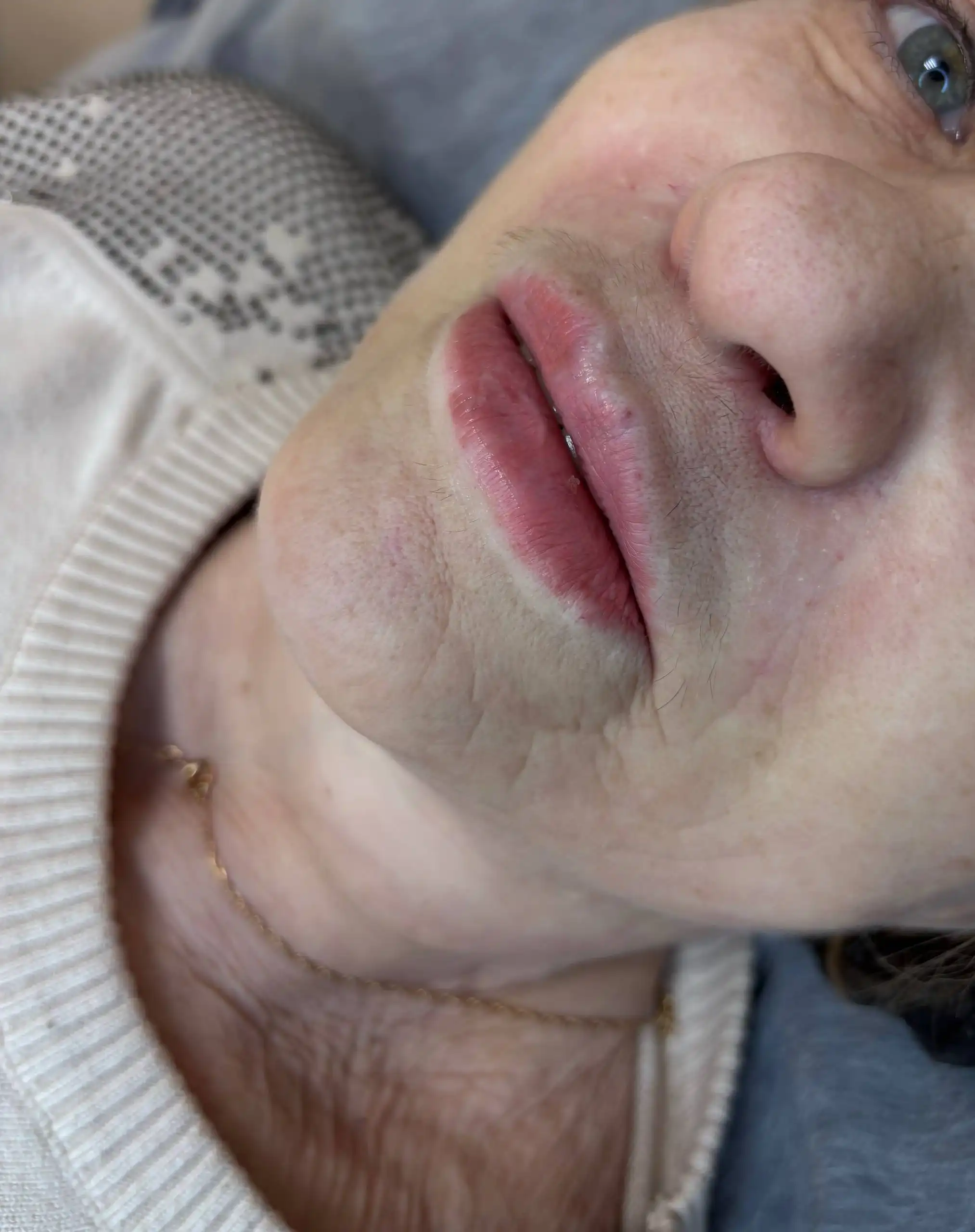 Набор моделей на увеличение губ