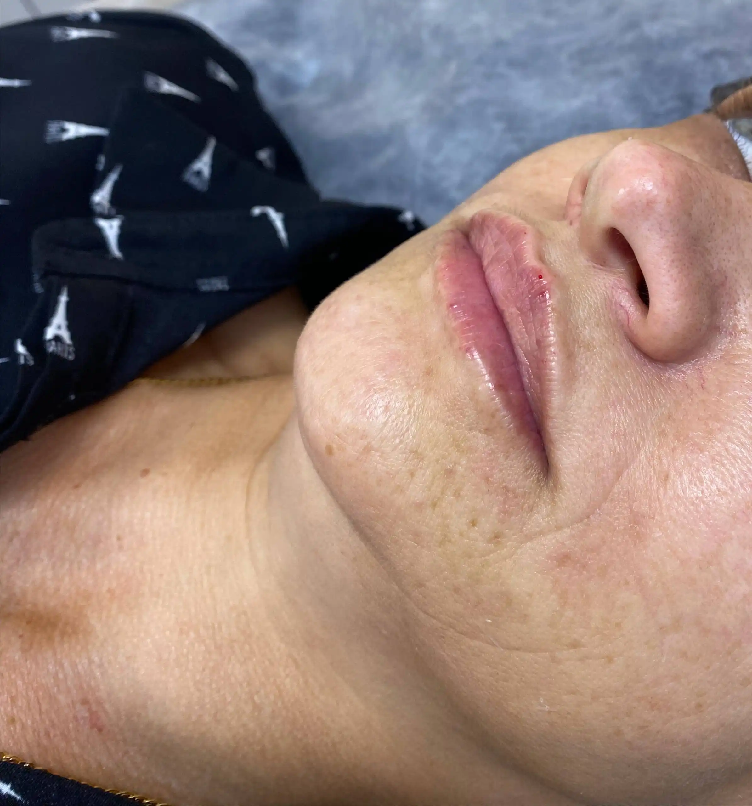 Набор моделей на увеличение губ