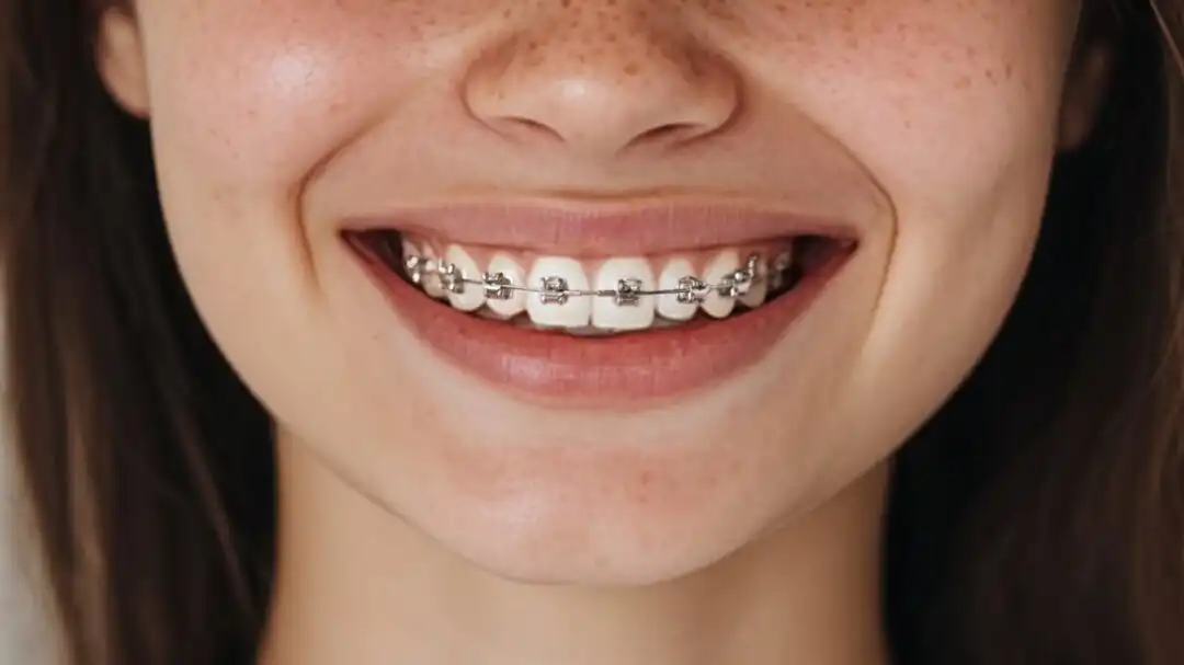 Брекеты для коррекции прикуса в Ставрополе