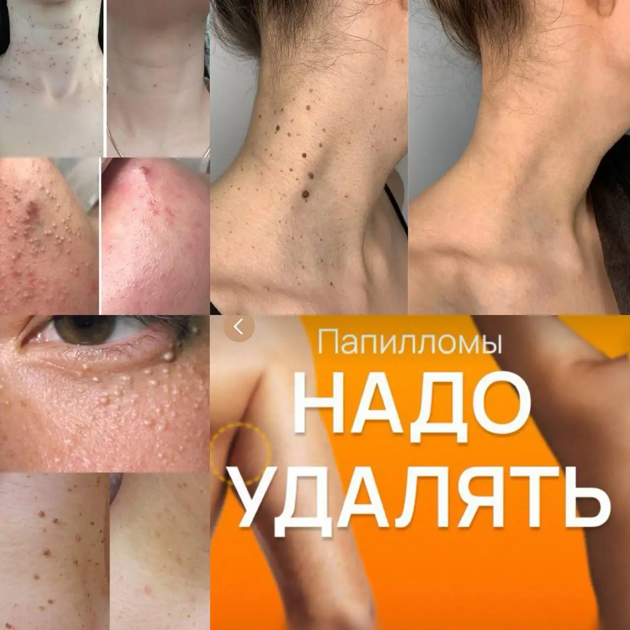Удаление папиллом и кожных образований - Косметологические услуги (Услуги) в Баклаши