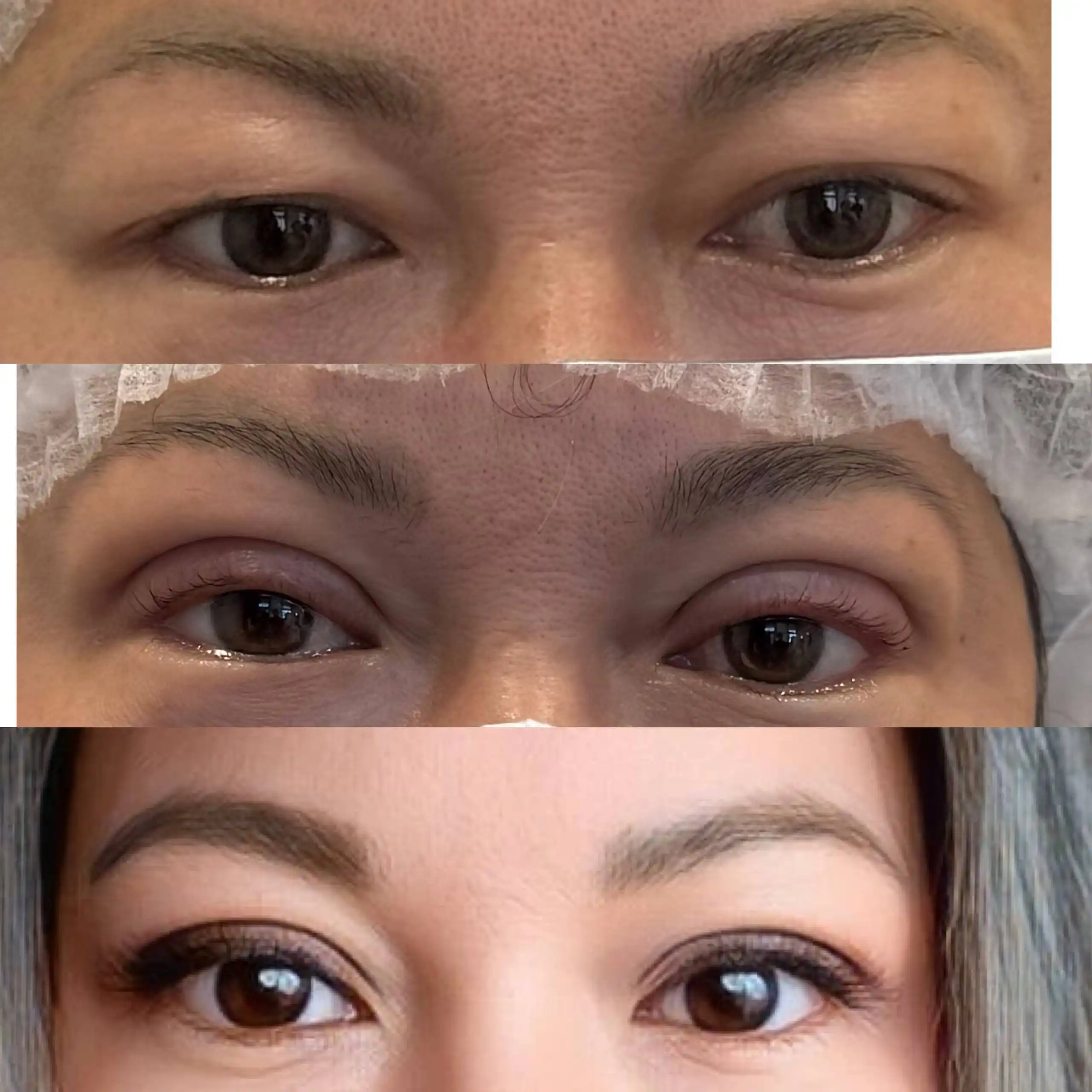 Услуги косметолога: нитевая блефаропластика и другие процедуры