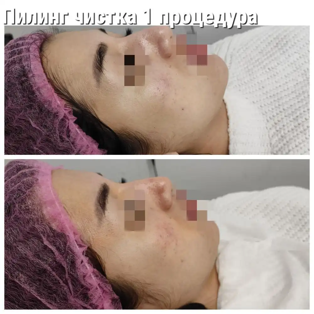 Требуются модели на пилинг и чистку лица - Косметология (Услуги) в Ангарск