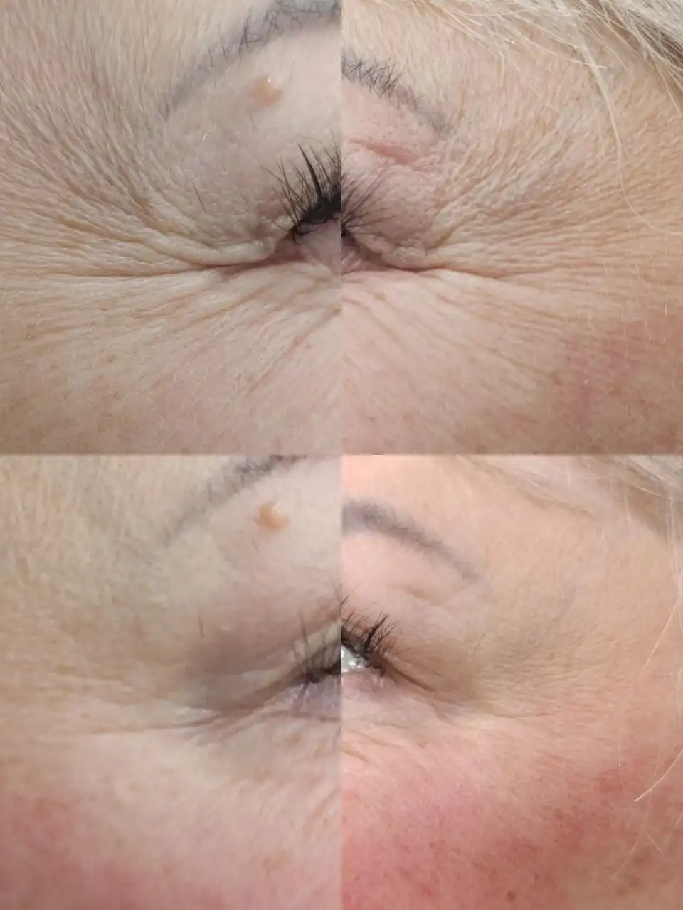 Ботокс верхней трети лица - Косметология (Услуги) в Ангарск