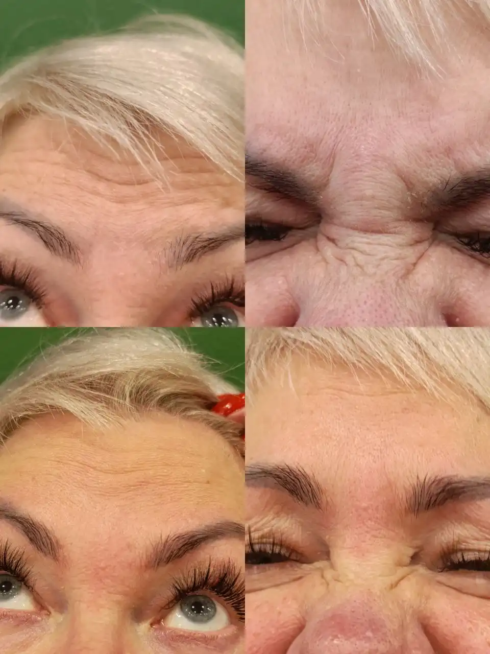 Ботокс верхней трети лица - Косметология (Услуги) в Ангарск