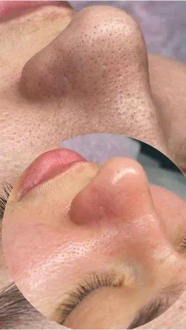 Ультразвуковая чистка лица от косметолога-эстетиста - частное объявление в Ангарск