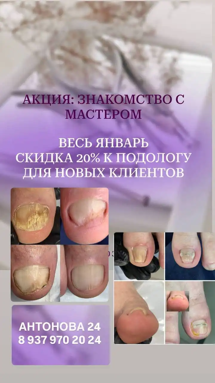 Прием у подолога со скидкой 20% в январе - Медицинские услуги (Услуги) в Саратов