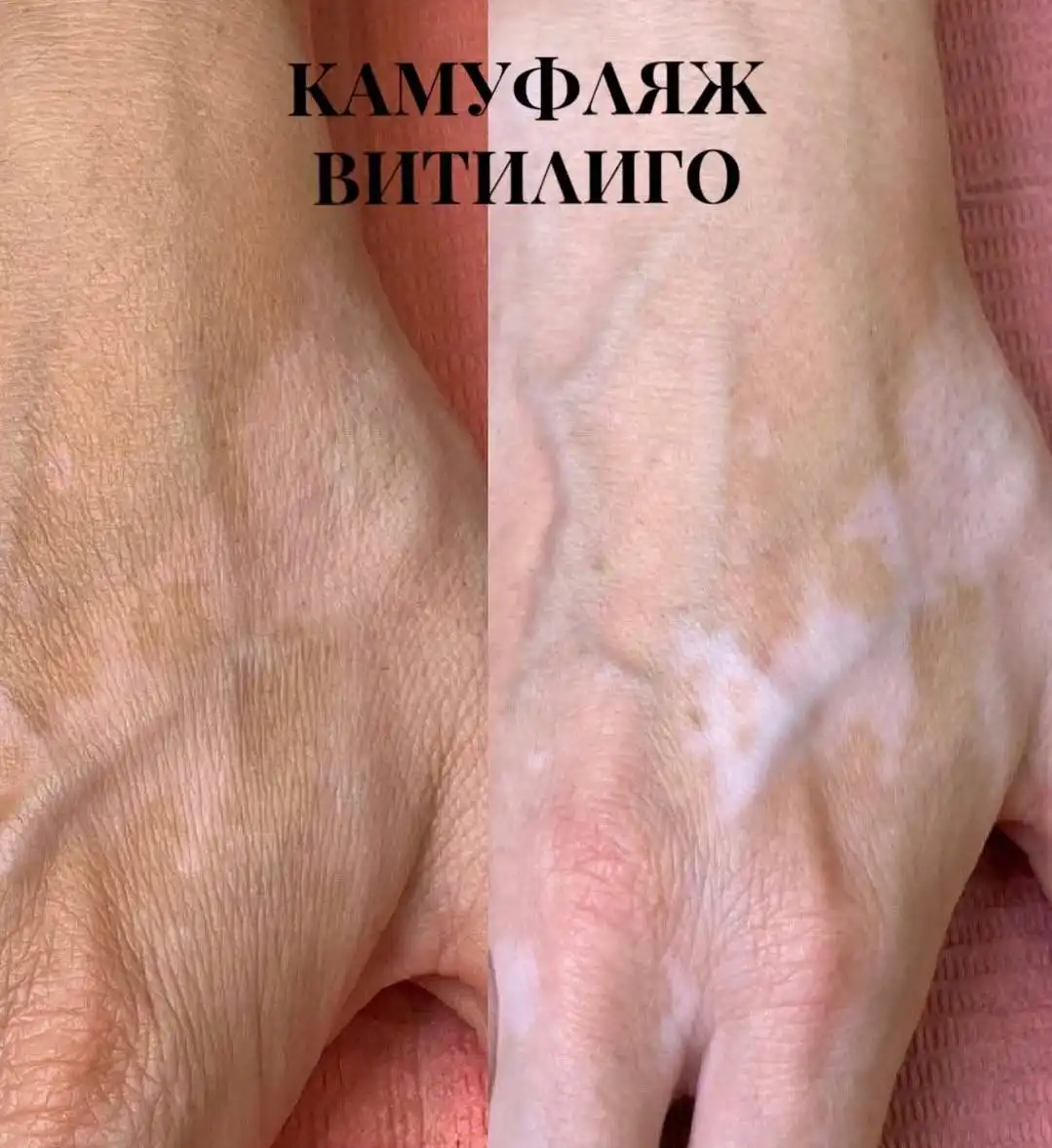 Эстетический камуфляж кожи в Нижнем Новгороде - Красота и здоровье (Услуги) в Нижний Новгород