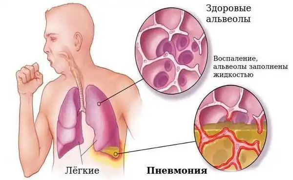 Баночный массаж от кашля в Иркутске
