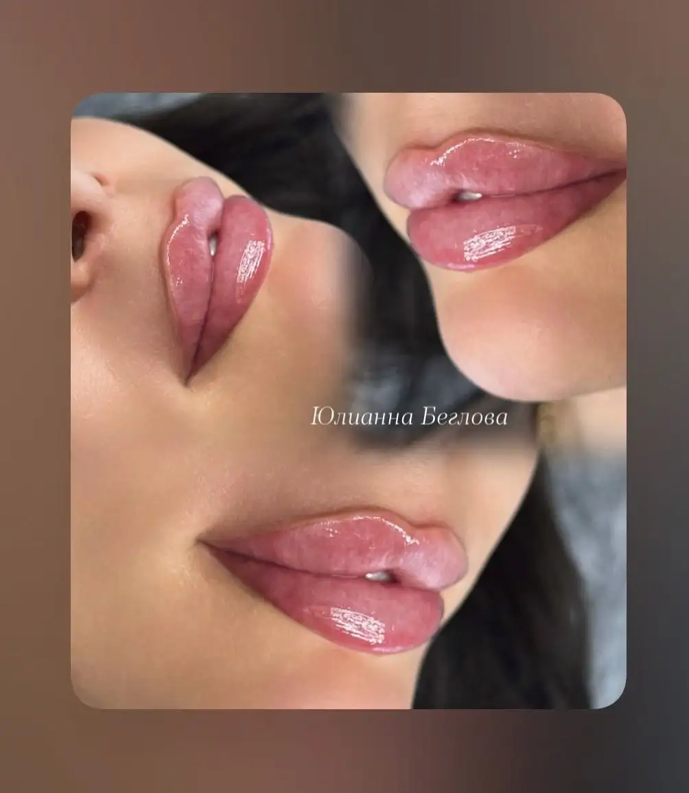 Увеличение губ премиальным препаратом из Кореи - Косметология (Красота и здоровье) в Иркутск
