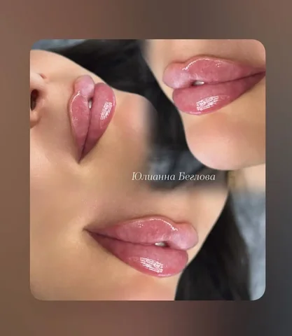 Увеличение губ премиальным препаратом из Кореи - Красота и здоровье в Иркутск