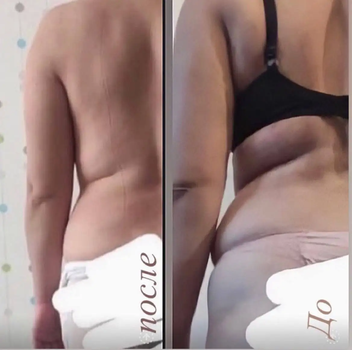 Криолиполиз - подготовка к летнему сезону - Красота и здоровье (Услуги) в Братск