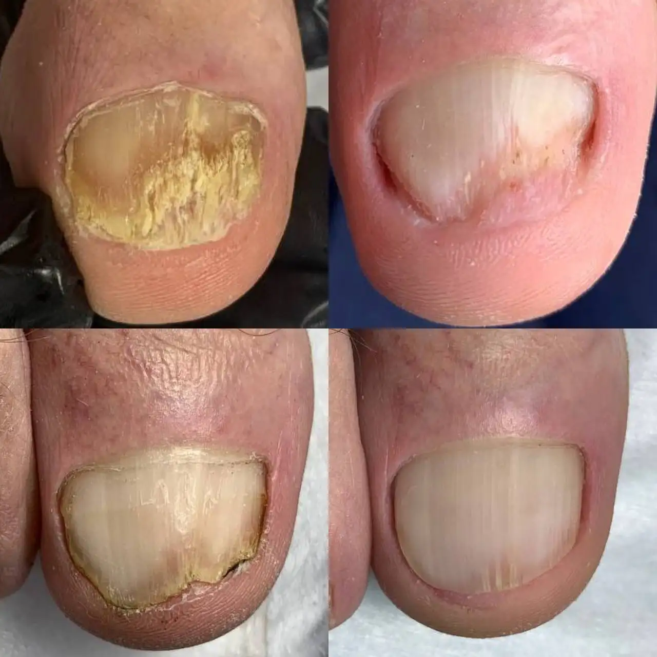 Педикюр и лечение ногтей в Студии НогтепилЪня - Красота и здоровье (Услуги) в Энгельс