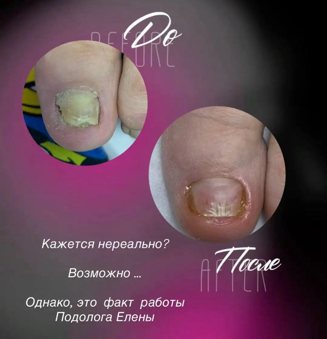 Консультация по проблемам с ногтями и стопами - Красота и здоровье (Услуги) в Энгельс