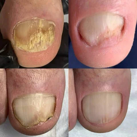 Консультация подолога в Студии НогтепилЪня - частное объявление в Энгельс