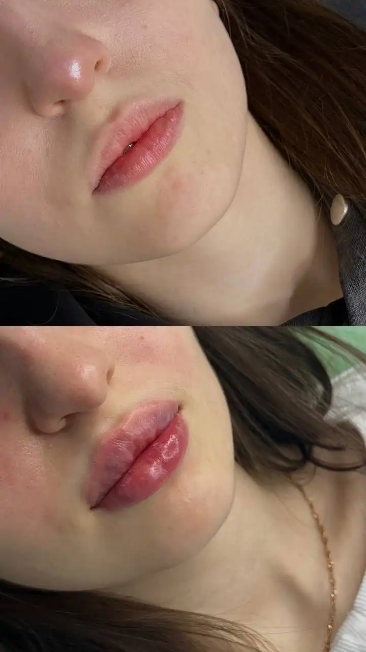 Увеличение губ