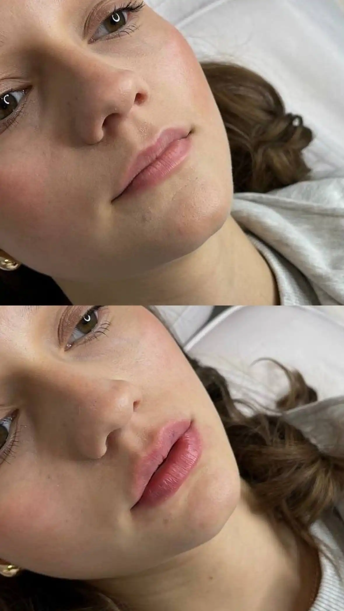 Увеличение губ