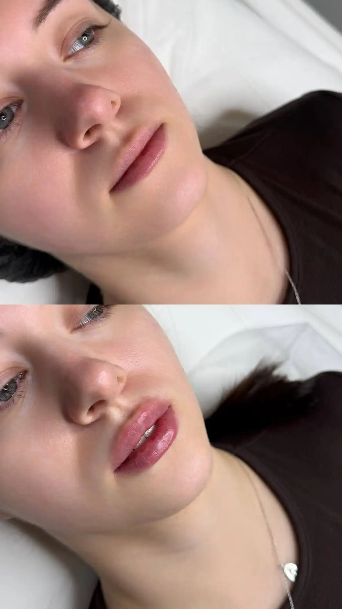 Увеличение губ