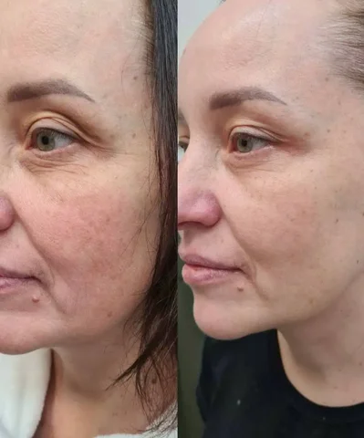 Массаж лица для лифтинга без уколов - Красота и здоровье в Чебоксары