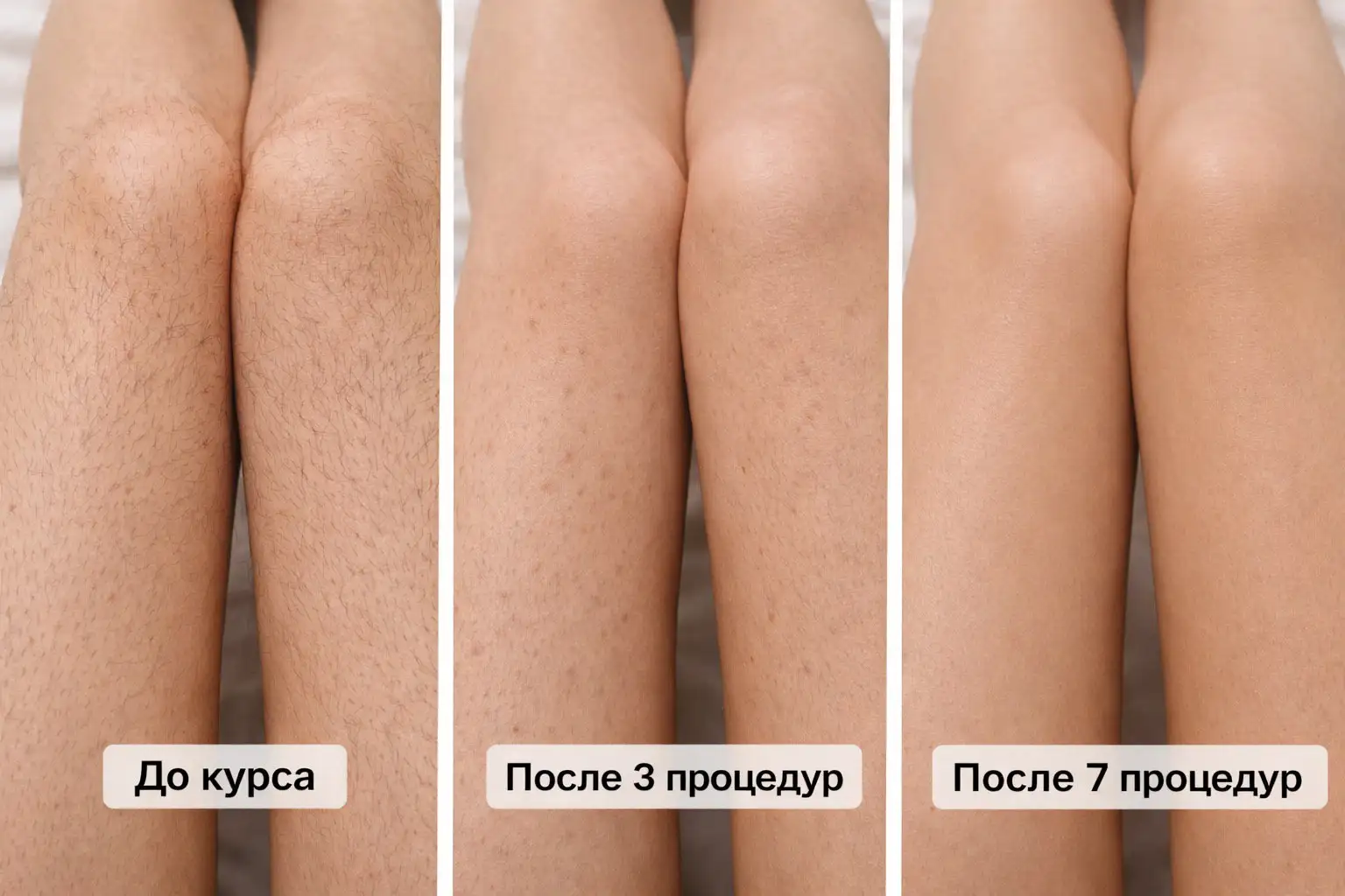 Лазерная эпиляция до и после курса процедур - Косметология (Услуги) в Севастополь