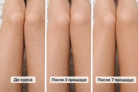 Лазерная эпиляция до и после курса процедур - Организация праздников в Севастополь
