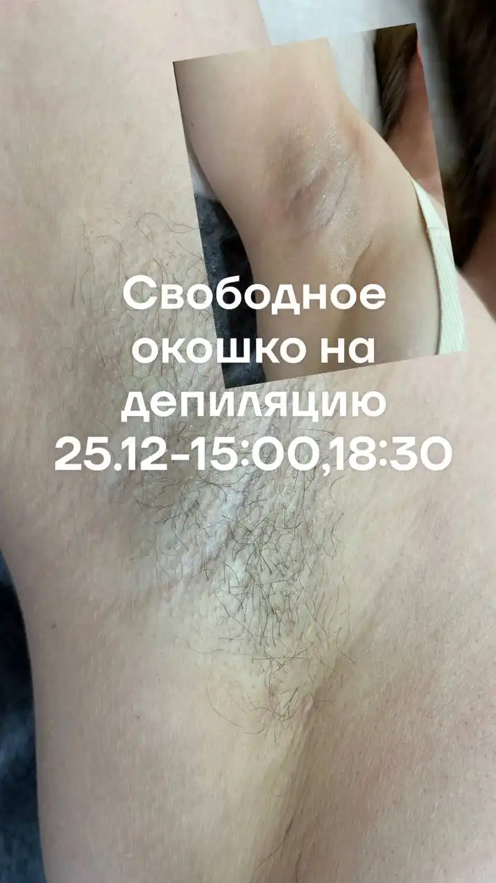 Запись на депиляцию сегодня