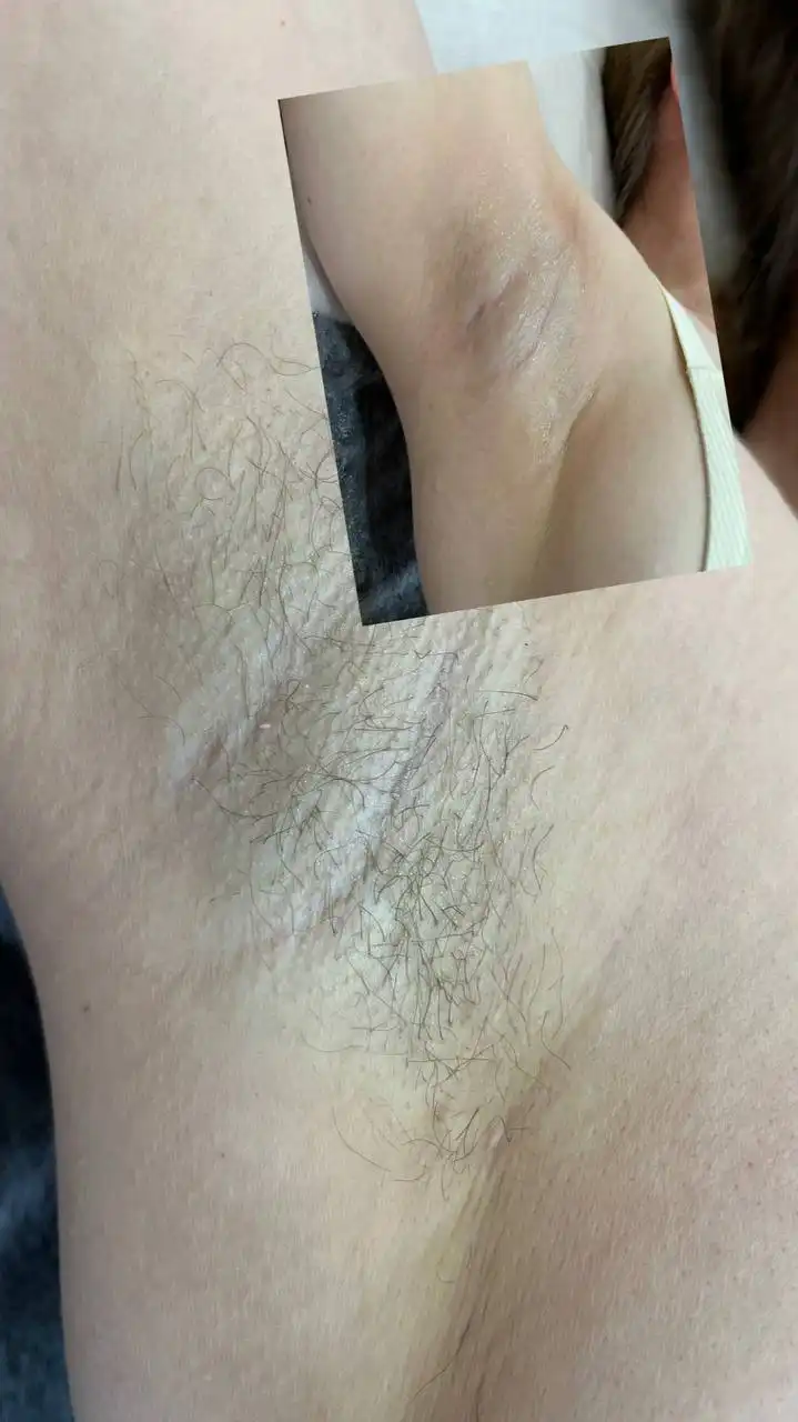 Депиляция в Нюр - Косметология (Услуги) в Чебоксары