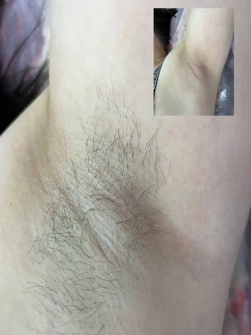 Депиляция в Нюр-Лента - Красота (Услуги) в Чебоксары