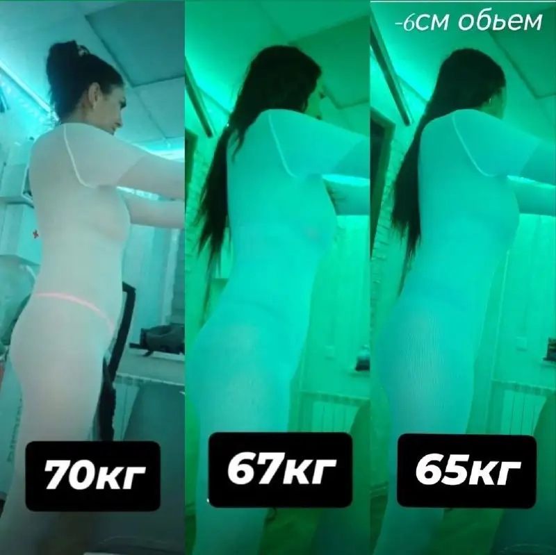 Криолиполиз: подготовка тела к летнему сезону - Косметология (Услуги) в Братск