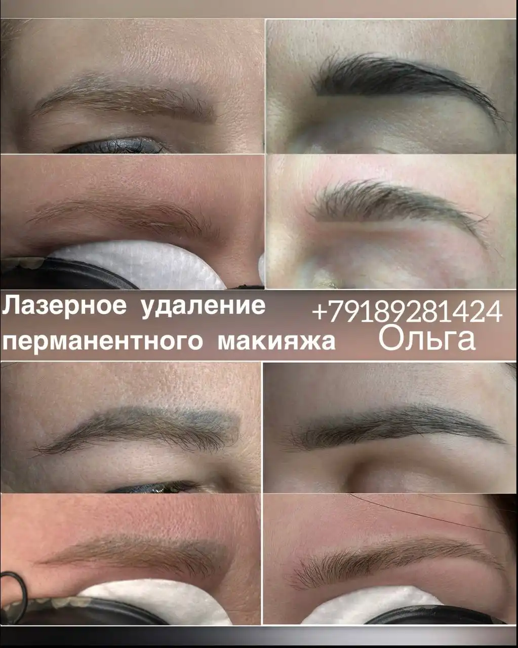 Лазерное удаление перманентного макияжа по специальной цене - Удаление татуажа (Красота и здоровье) в Краснодар