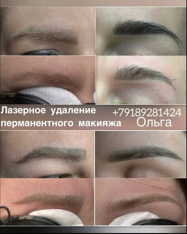 Лазерное удаление перманентного макияжа по специальной цене - Аппаратная косметология в Краснодар