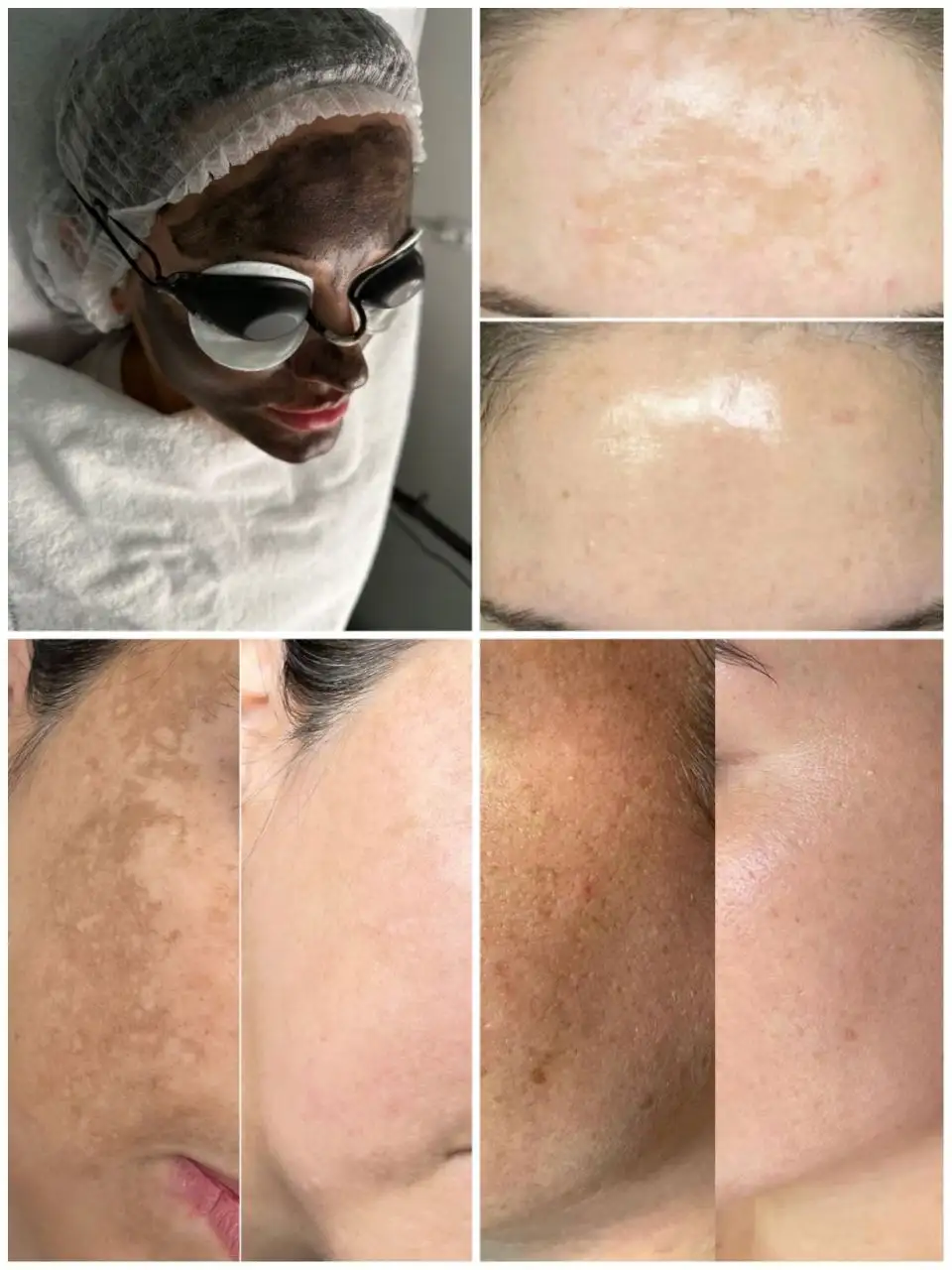 Карбоновый пилинг в Краснодаре - Пилинг (Красота и здоровье) в Краснодар