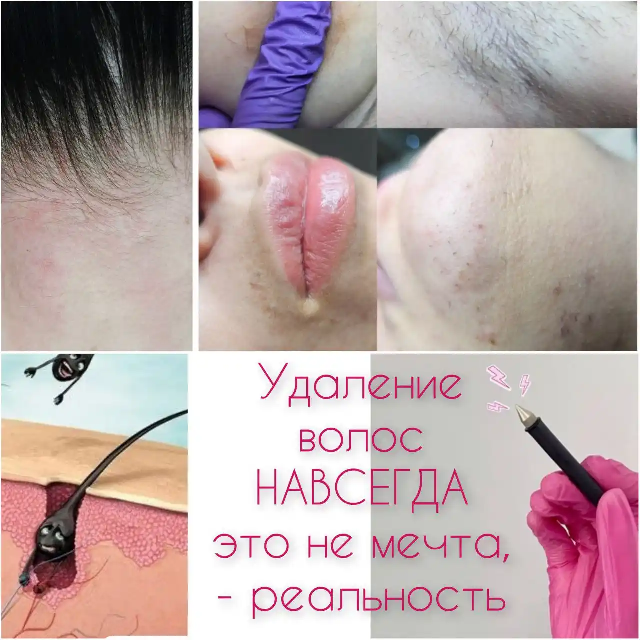 Электроэпиляция навсегда - Красота и здоровье в Краснодар