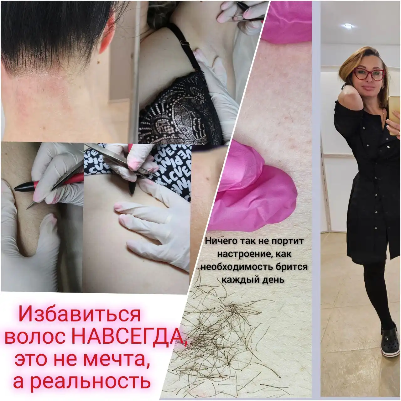 Электроэпиляция навсегда