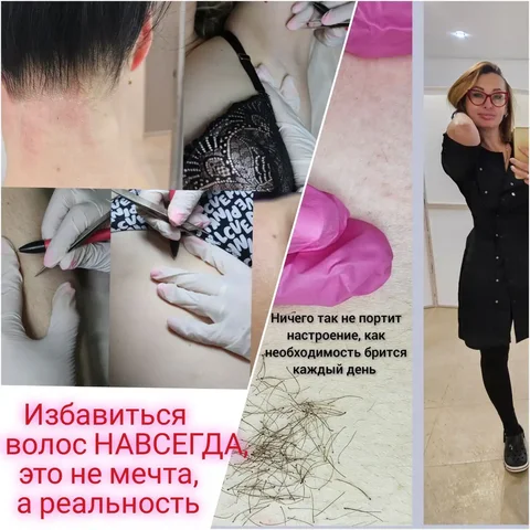 Электроэпиляция навсегда - Услуги в Краснодар