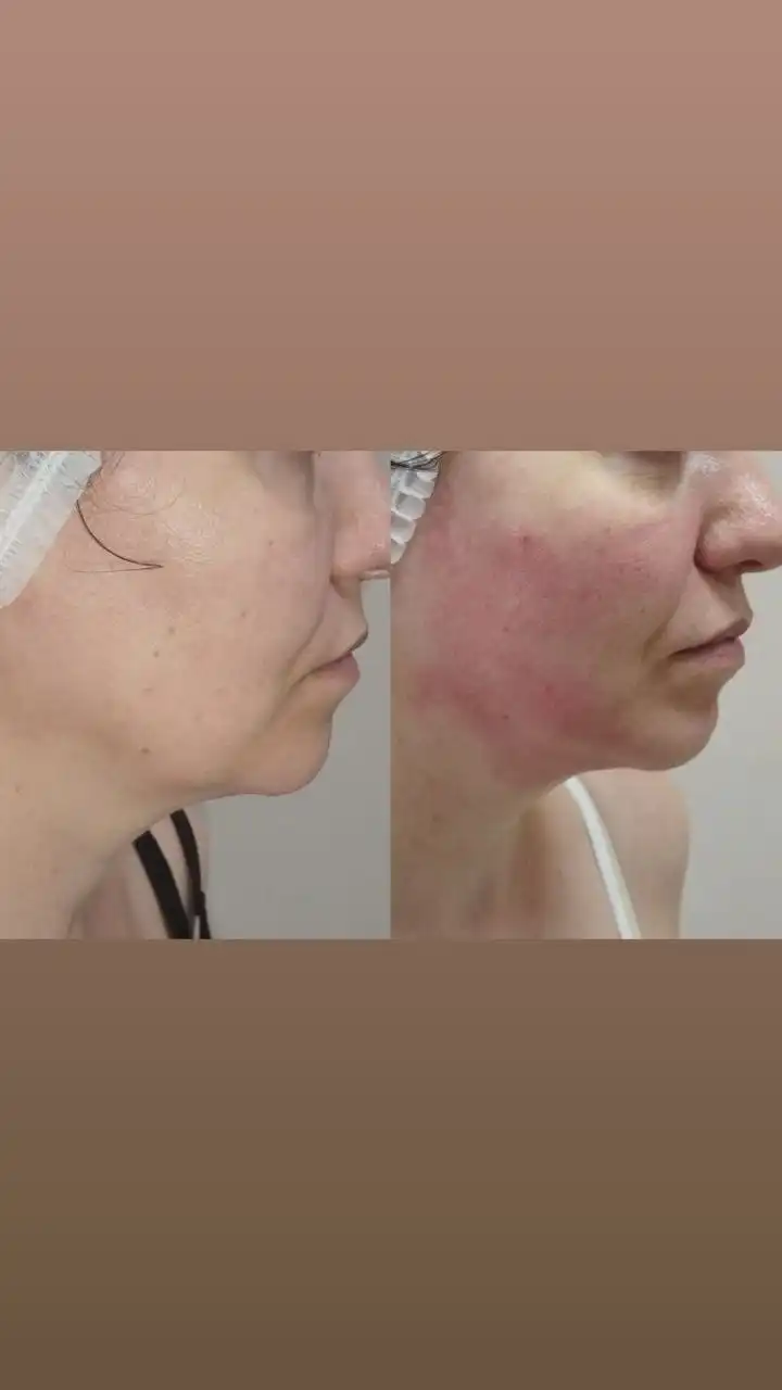 Микроигольчатый рф лифтинг в Самаре