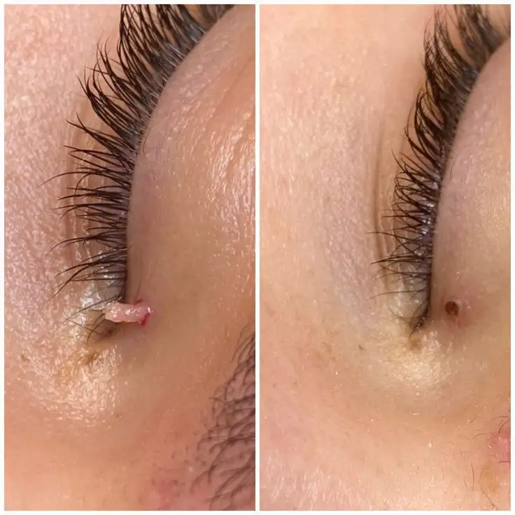 Удаление папиллом, родинок, бородавок - Медицинские услуги (Услуги) в Саратов