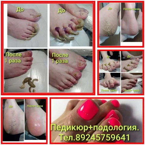 Профессиональный педикюр от подолога с 10-летним стажем в Чите - частное объявление в Чита