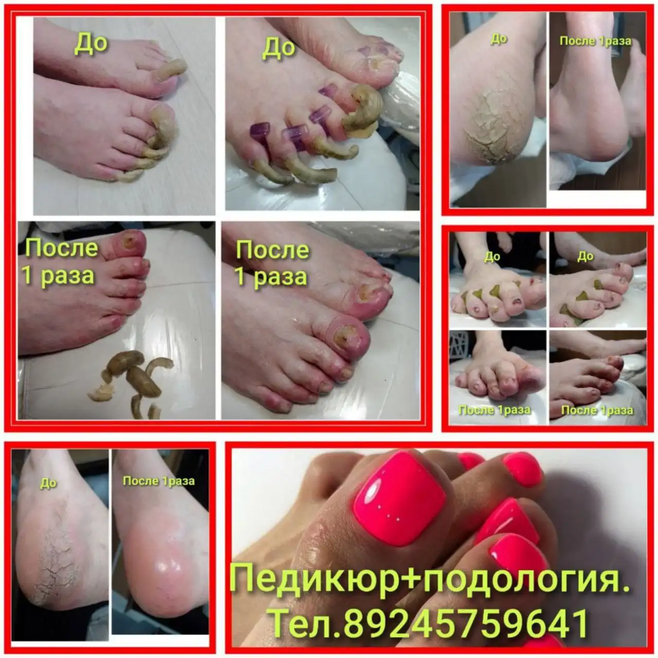 Профессиональный педикюр с полной обработкой проблемных стоп и ногтей в Чите