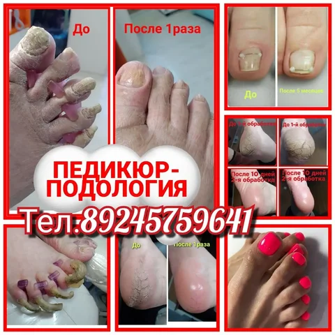 Профессиональный педикюр проблемных стоп и ногтей в Чите - Художественные услуги / Дизайн в Чита