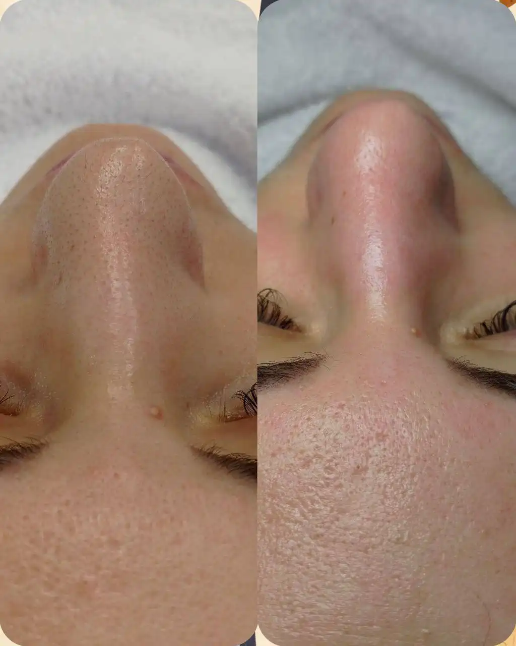 Чистка лица и уход за кожей