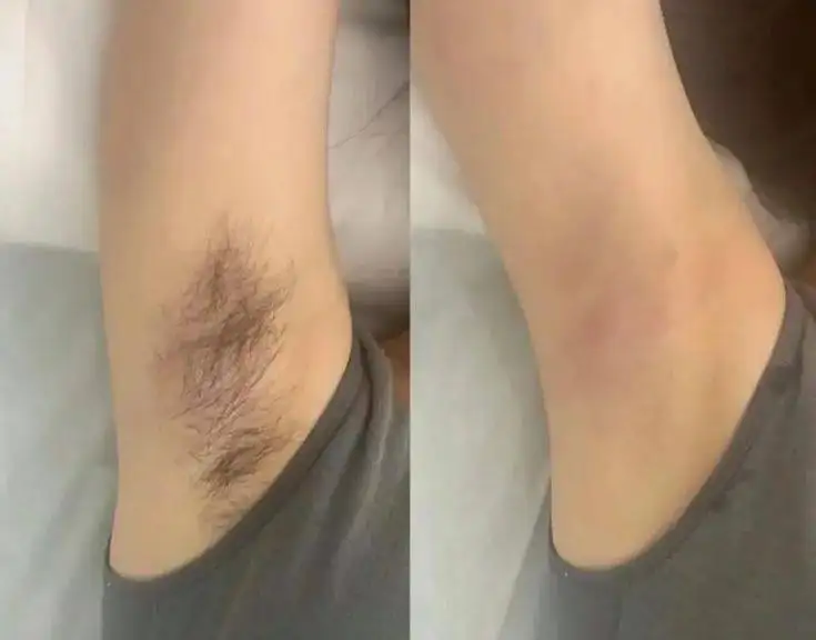 Депиляция в мастерской здоровья и красоты - Красота и здоровье (Услуги) в Сургут