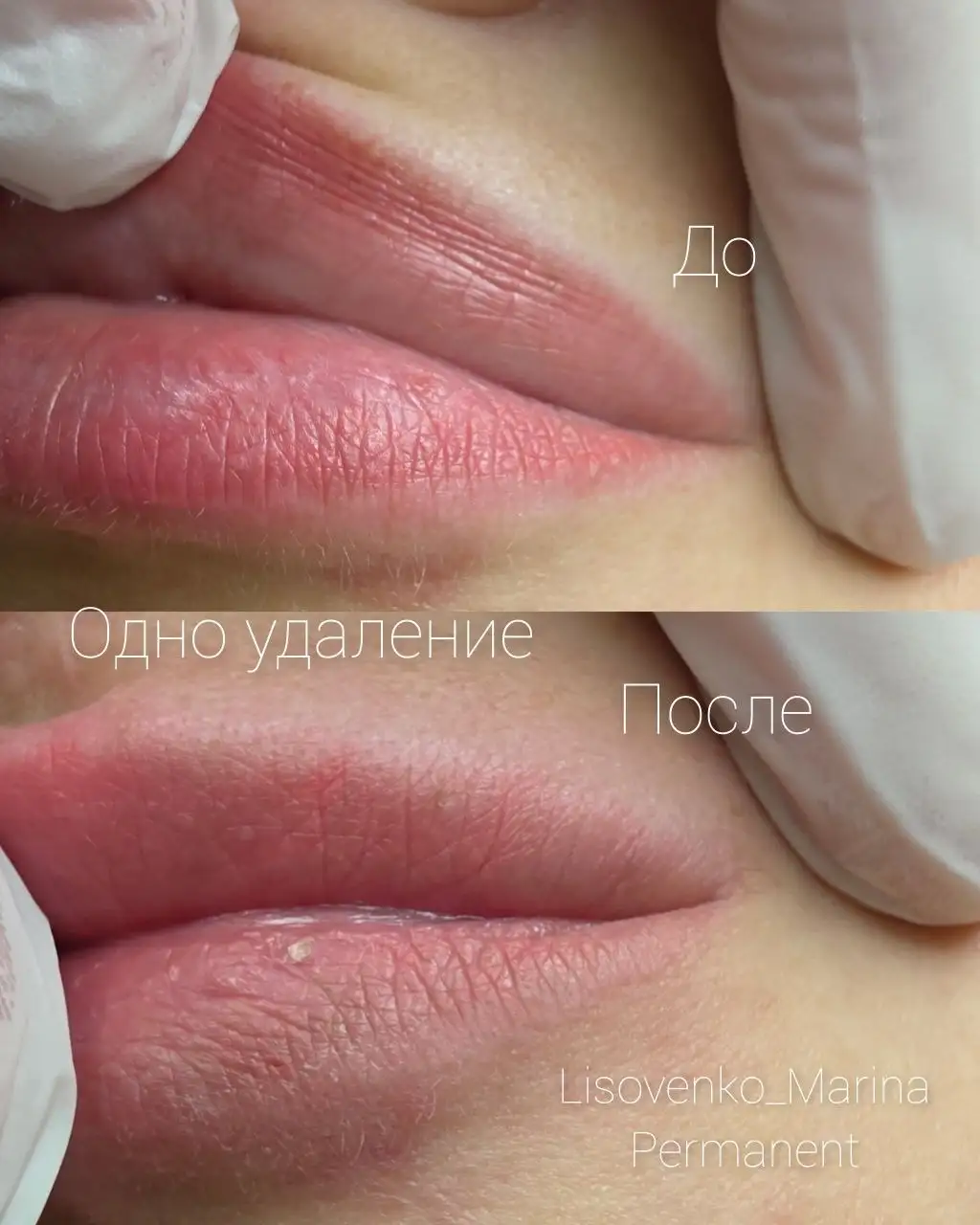 Удаление татуажа губ и век на 22 апреля - Услуги в Сургут